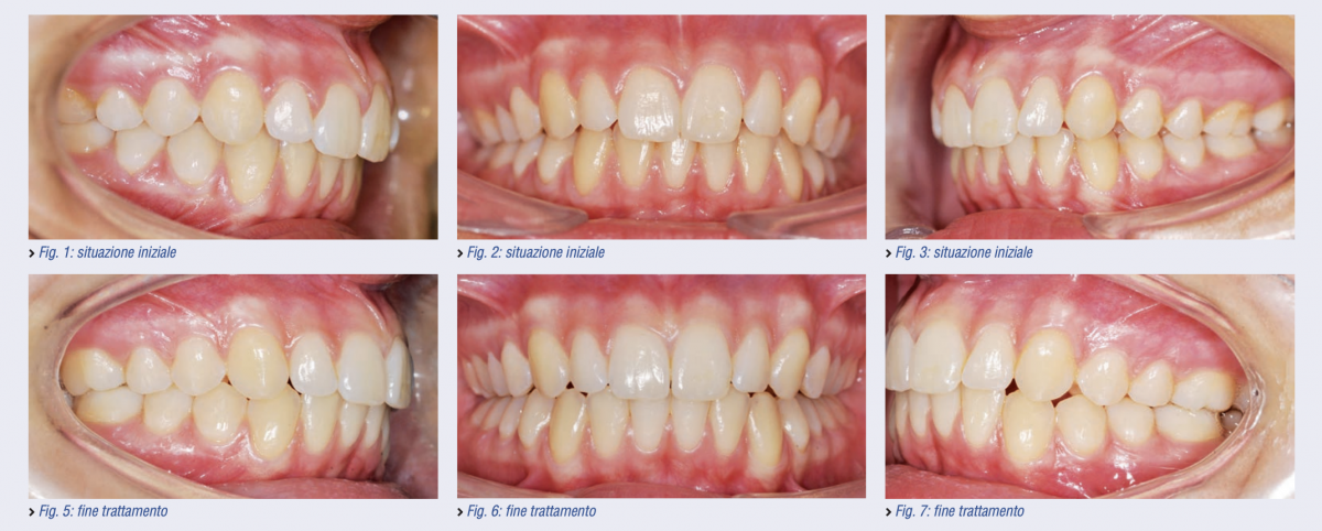 Trattamento ortodontico di asimmetria dento-alveolare digitale 3D