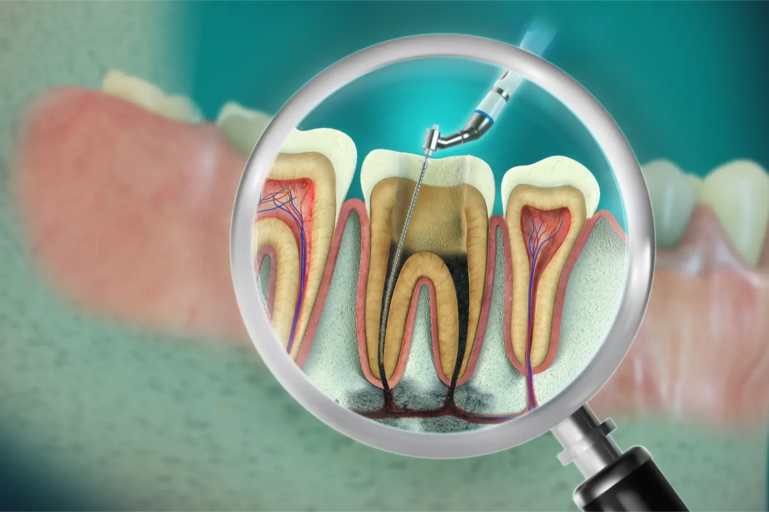 Illustrazione della devitalizzazione del canale radicolare con strumento endodontico
