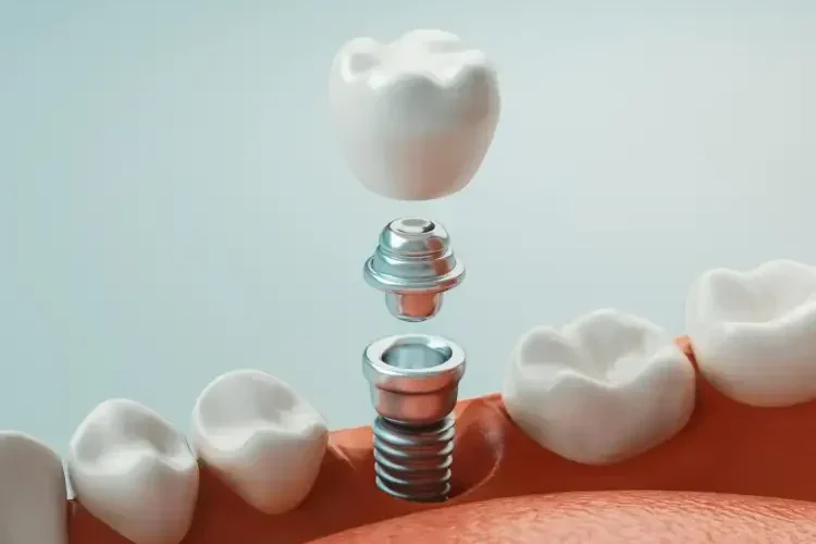 Illustrazione 3D della struttura di un impianto dentale con vite, moncone e corona, Studio Isaza Bologna