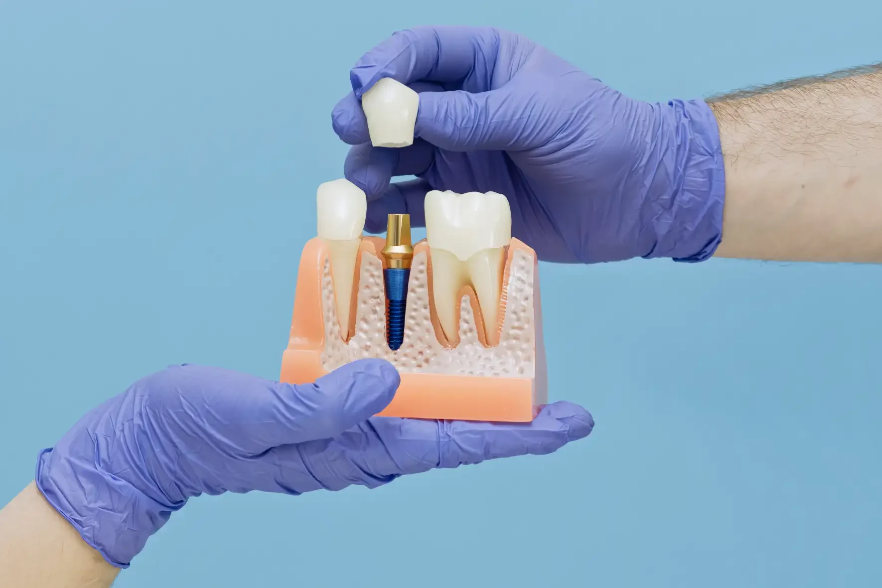Modello anatomico che mostra l'inserimento di un impianto dentale nella mascella