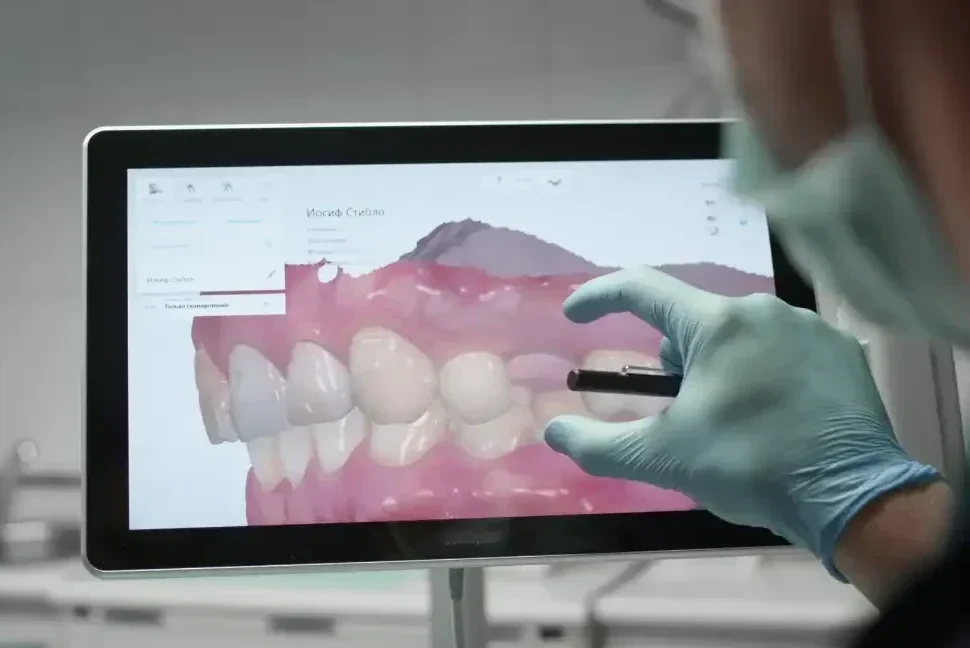 Modello 3D dell'arcata dentale su schermo dopo scansione intraorale