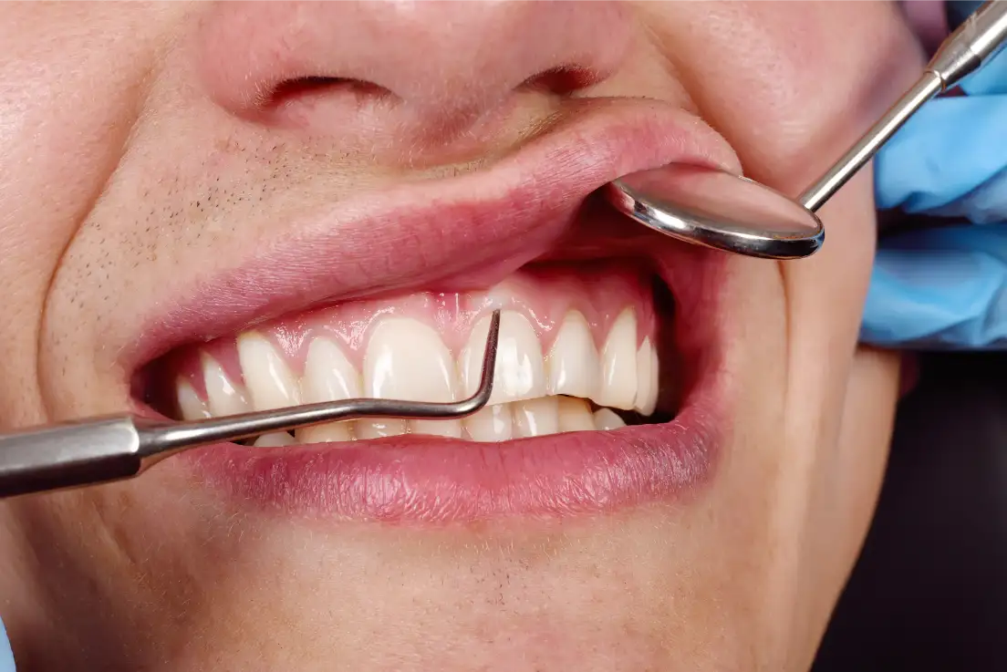 Dentista che esegue sondaggio parodontale su paziente, Studio Isaza Bologna