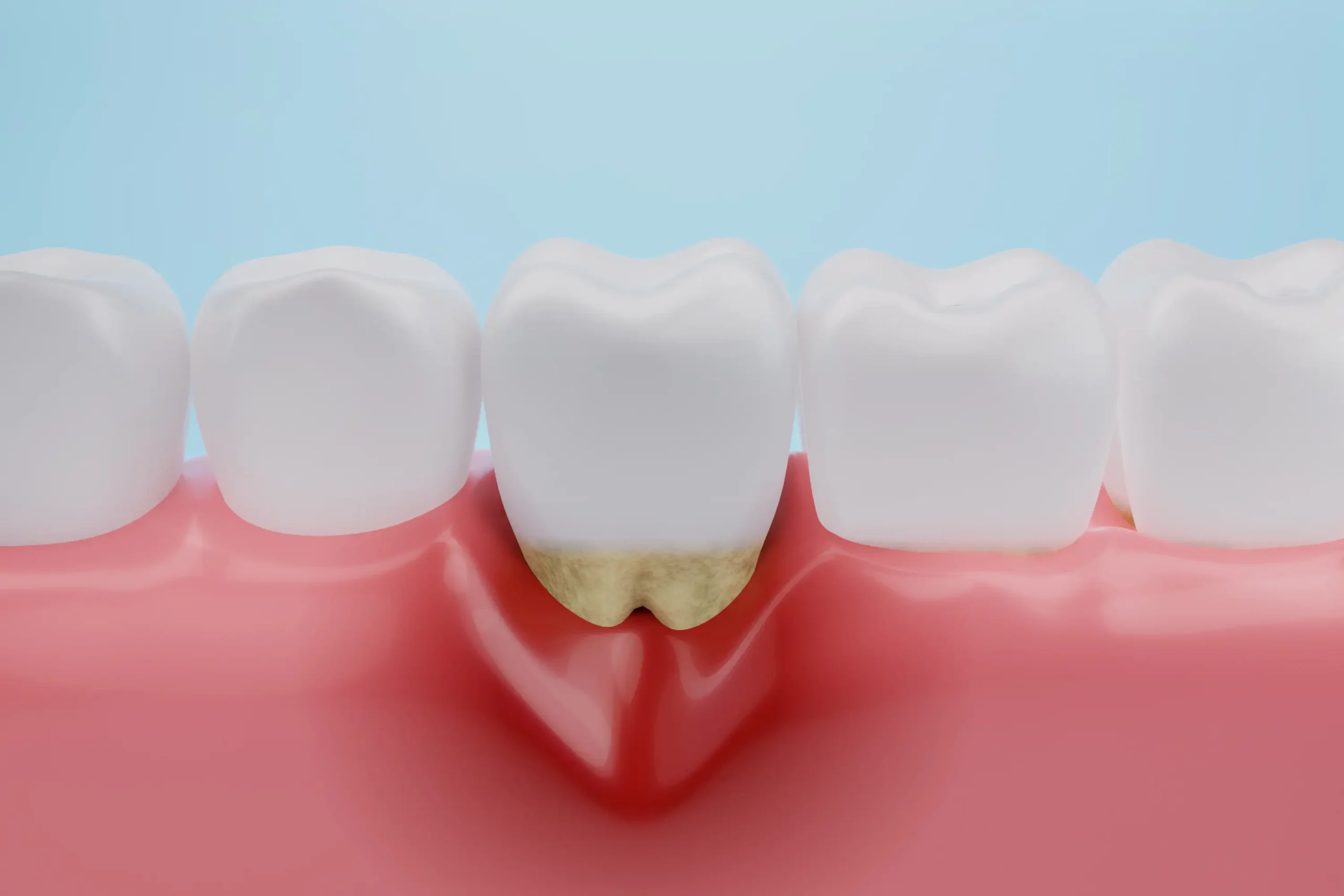 Illustrazione 3D di tasca parodontale con infiammazione gengivale