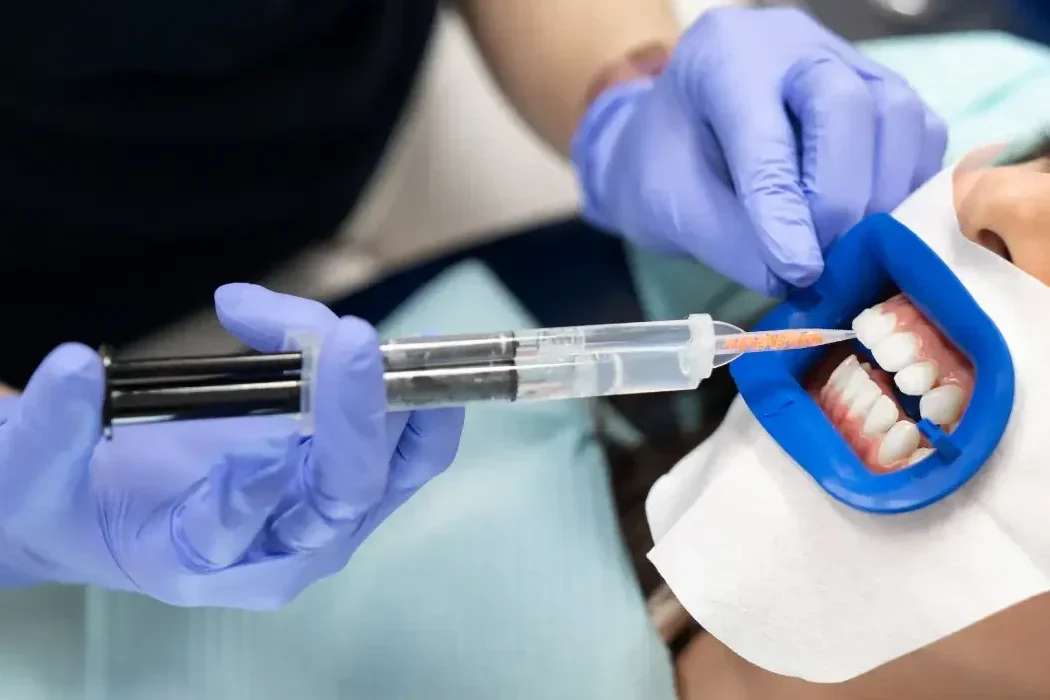 Dentista che applica gel sbiancante sui denti con siringa professionale, Studio Isaza Bologna